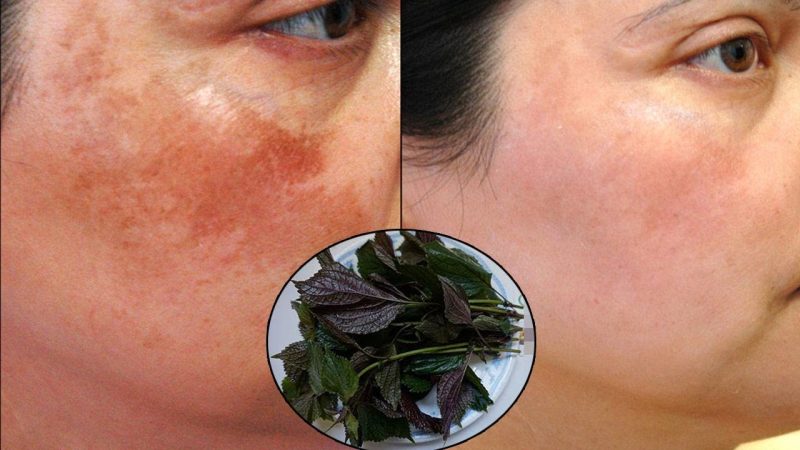 TOP 3 cách trị nám chân sâu bằng lá tía tô hiệu quả